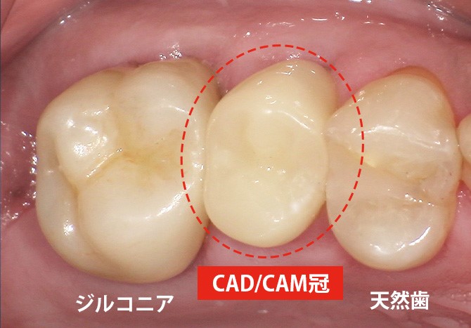 CAD/CAM冠（保険適用）