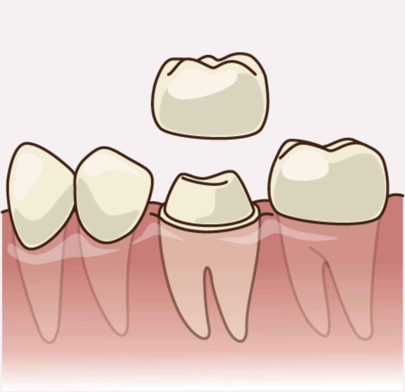 治療中の仮歯（かりば）の大切な役割について　〜仮歯は被せ物治療の予行演習〜