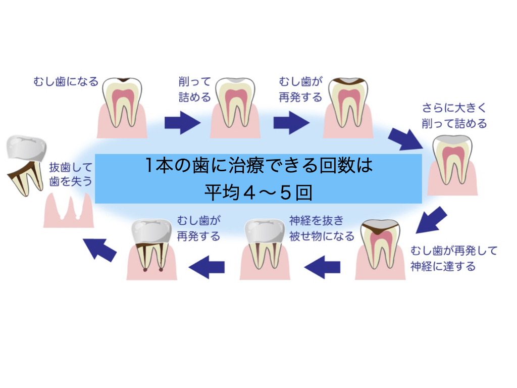 歯の治療は何回でもできるわけではありません　〜治療の限界の回数について〜