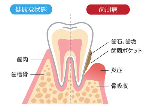 歯周病は歯を支える骨が溶ける病気　〜気づきにくい沈黙の病と言われています〜
