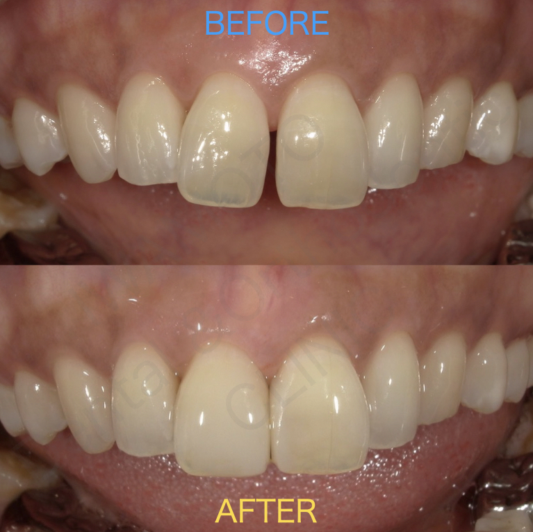 すきっ歯の治療を3種類解説・比較　〜ダイレクトボンディングで短期間で治療したケース〜